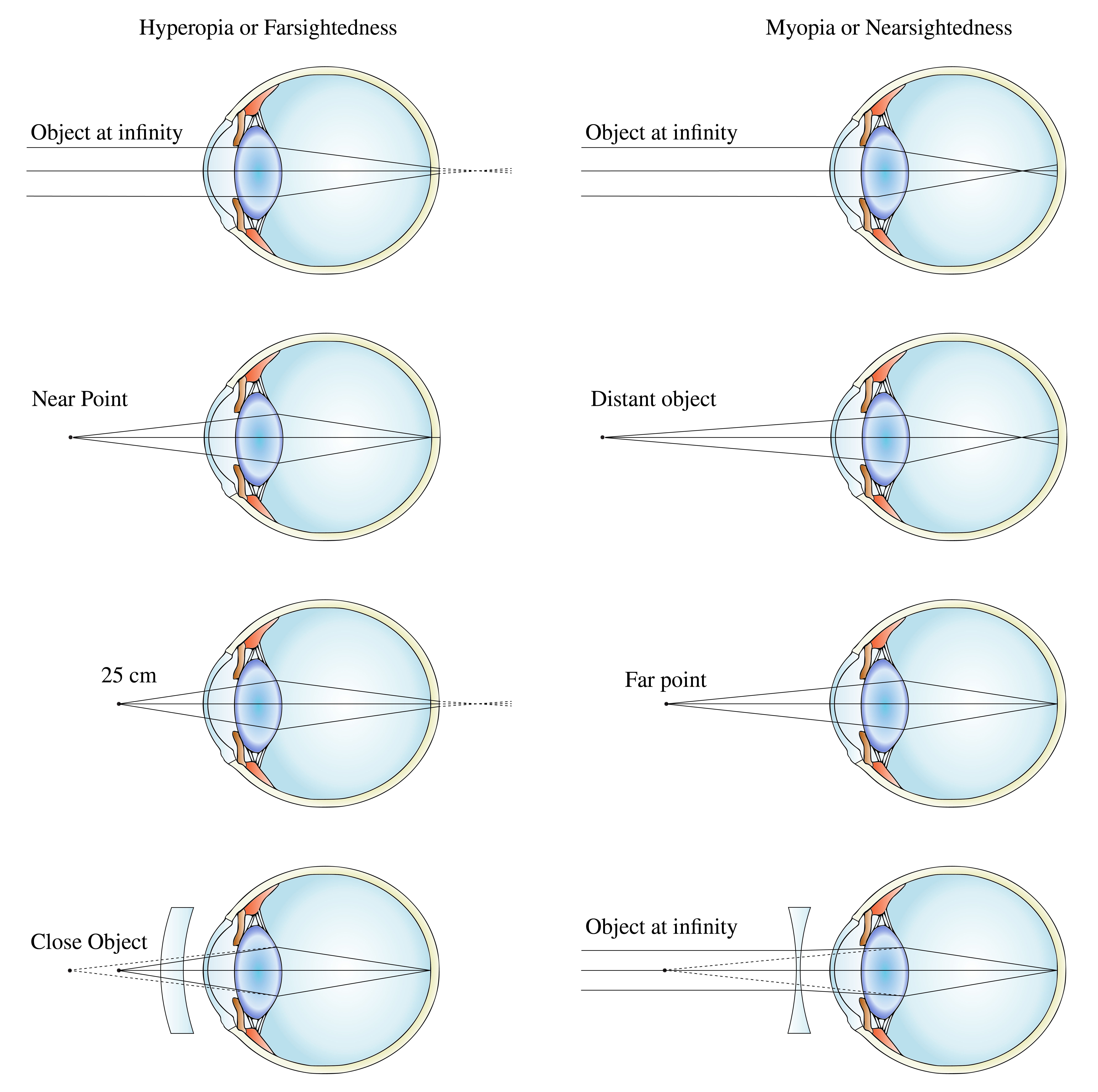 Correction of farsighted (left) and nearsighted (right) eye (adapted from Wikimedia Commons by Gumenyuk I.S. / CC BY-SA 4.0).