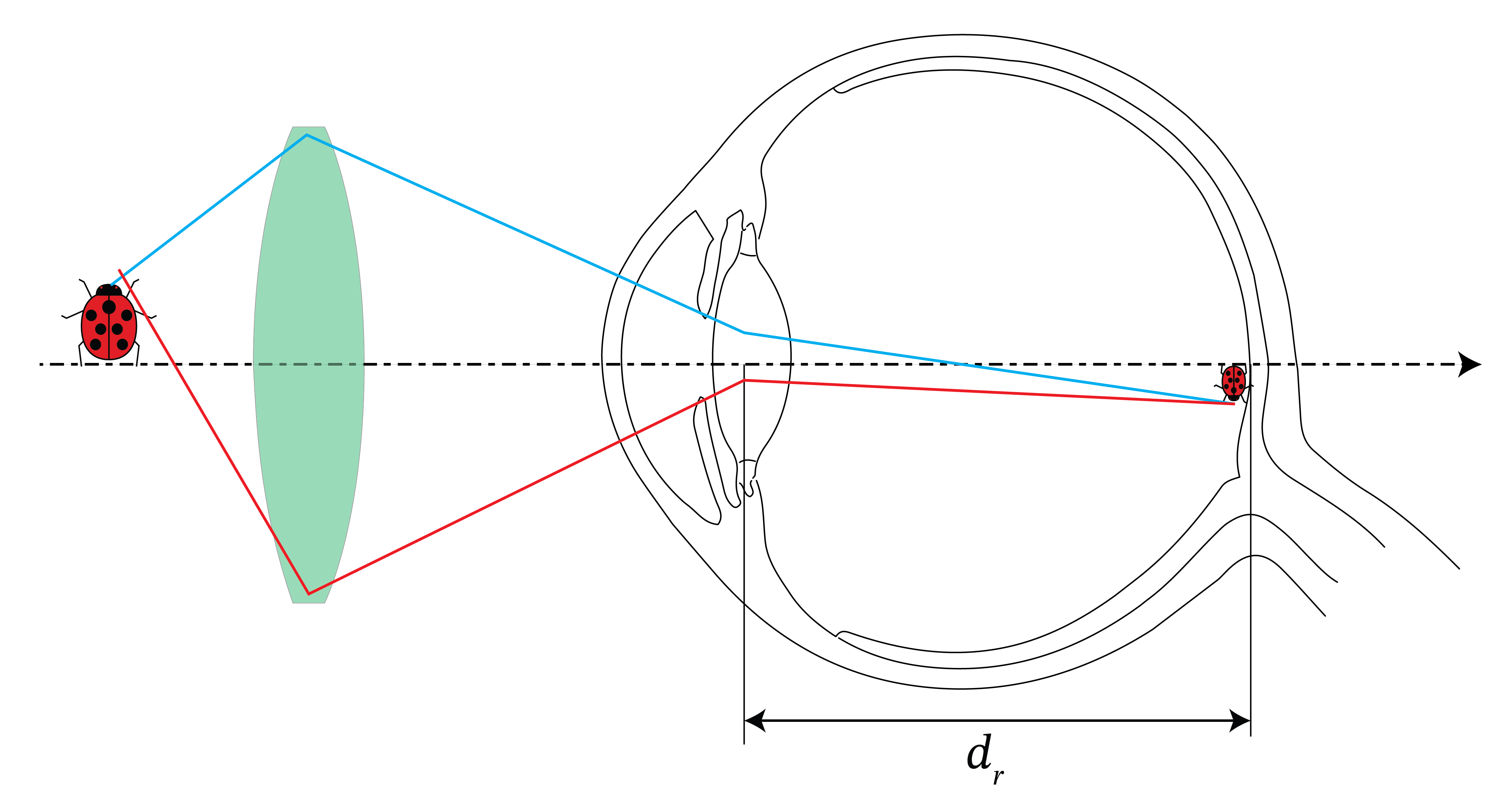 Angular view \alpha_u without and with the use of a negative lens.